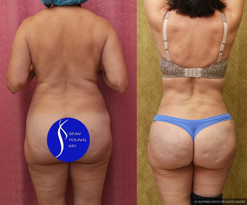 Tummy Tuck (Abdominoplasty) Small Size Before & After Patient #15025