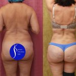 Tummy Tuck (Abdominoplasty) Small Size Before & After Patient #15025