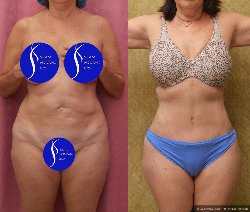 Tummy Tuck (Abdominoplasty) Small Size Before & After Patient #15025