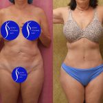 Tummy Tuck (Abdominoplasty) Small Size Before & After Patient #15025