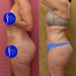 Tummy Tuck (Abdominoplasty) Small Size Before & After Patient #15025