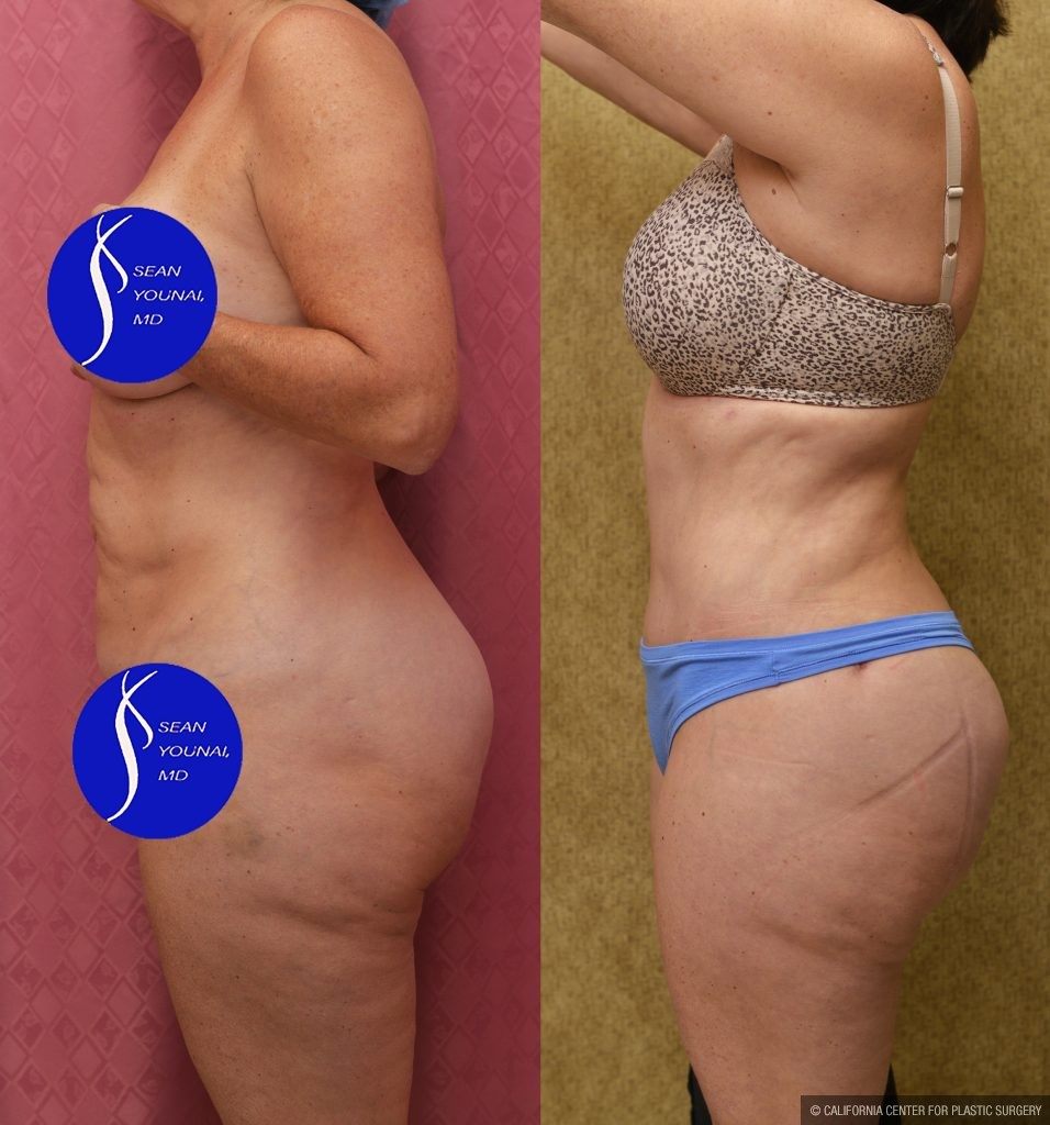 Tummy Tuck (Abdominoplasty) Small Size Before & After Patient #15025