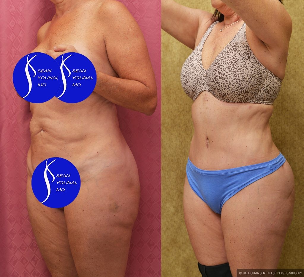 Tummy Tuck (Abdominoplasty) Small Size Before & After Patient #15025
