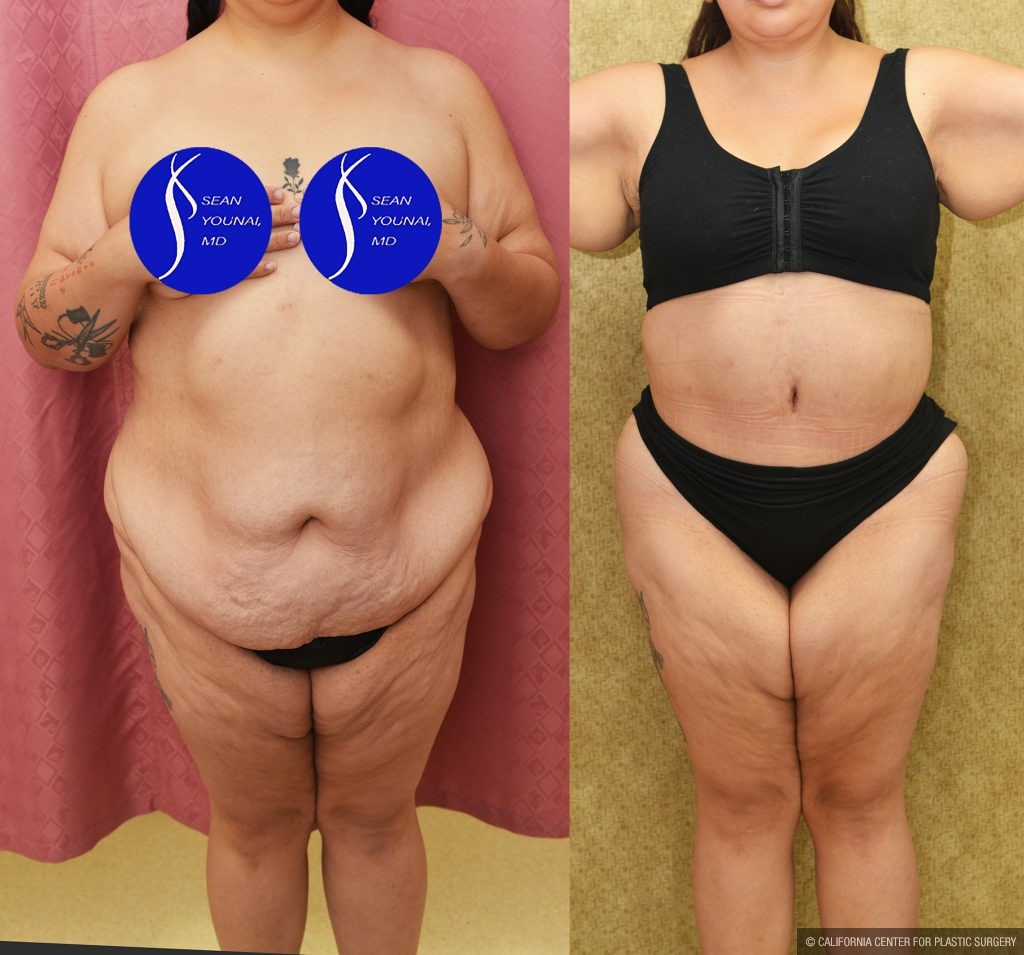 Tummy Tuck (Abdominoplasty) Super Plus Size Before & After Patient #15026
