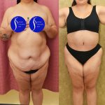 Tummy Tuck (Abdominoplasty) Super Plus Size Before & After Patient #15026