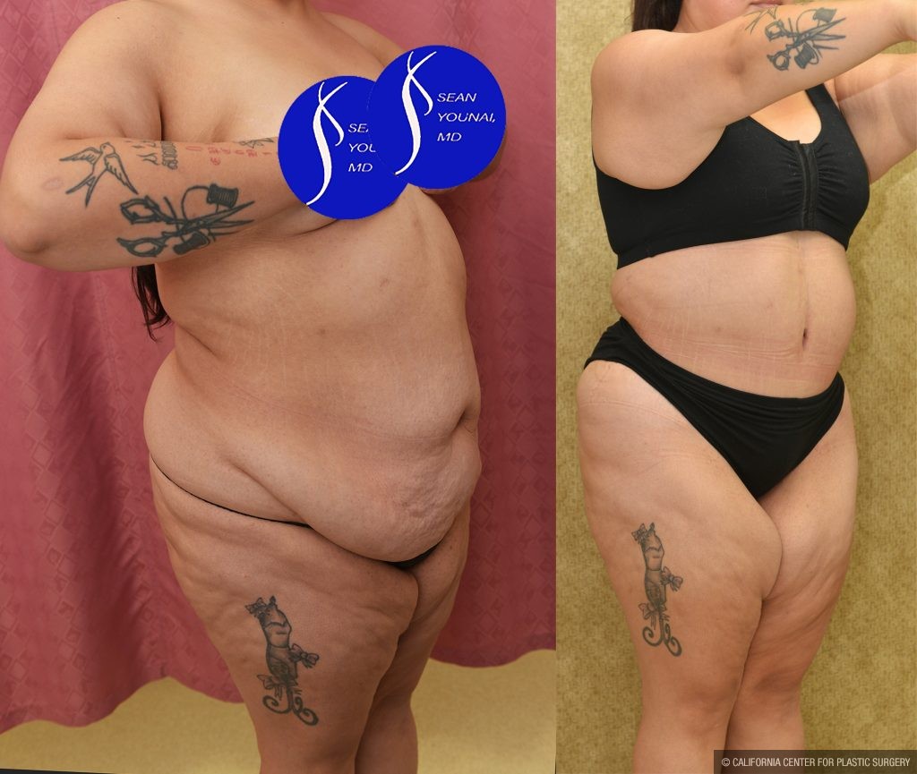 Tummy Tuck (Abdominoplasty) Super Plus Size Before & After Patient #15026