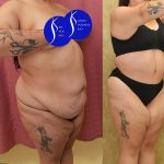 Tummy Tuck (Abdominoplasty) Super Plus Size Before & After Patient #15026
