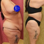 Tummy Tuck (Abdominoplasty) Super Plus Size Before & After Patient #15026