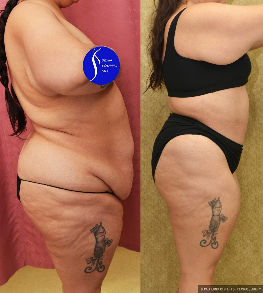 Tummy Tuck (Abdominoplasty) Super Plus Size Before & After Patient #15026