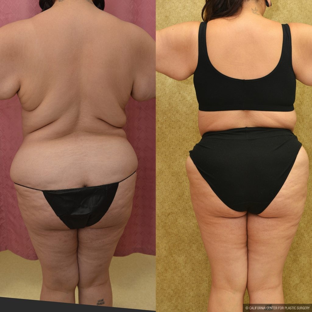 Tummy Tuck (Abdominoplasty) Super Plus Size Before & After Patient #15026