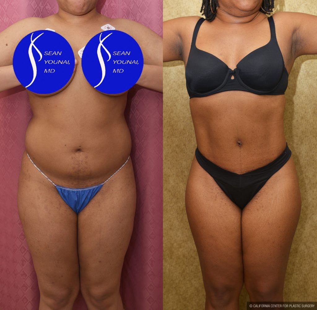 Liposuction Abdomen Medium Before & After Patient #15023