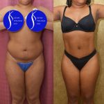Liposuction Abdomen Medium Before & After Patient #15023