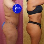 Liposuction Abdomen Medium Before & After Patient #15023