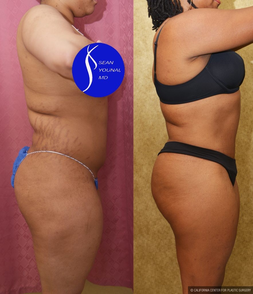 Liposuction Abdomen Medium Before & After Patient #15023