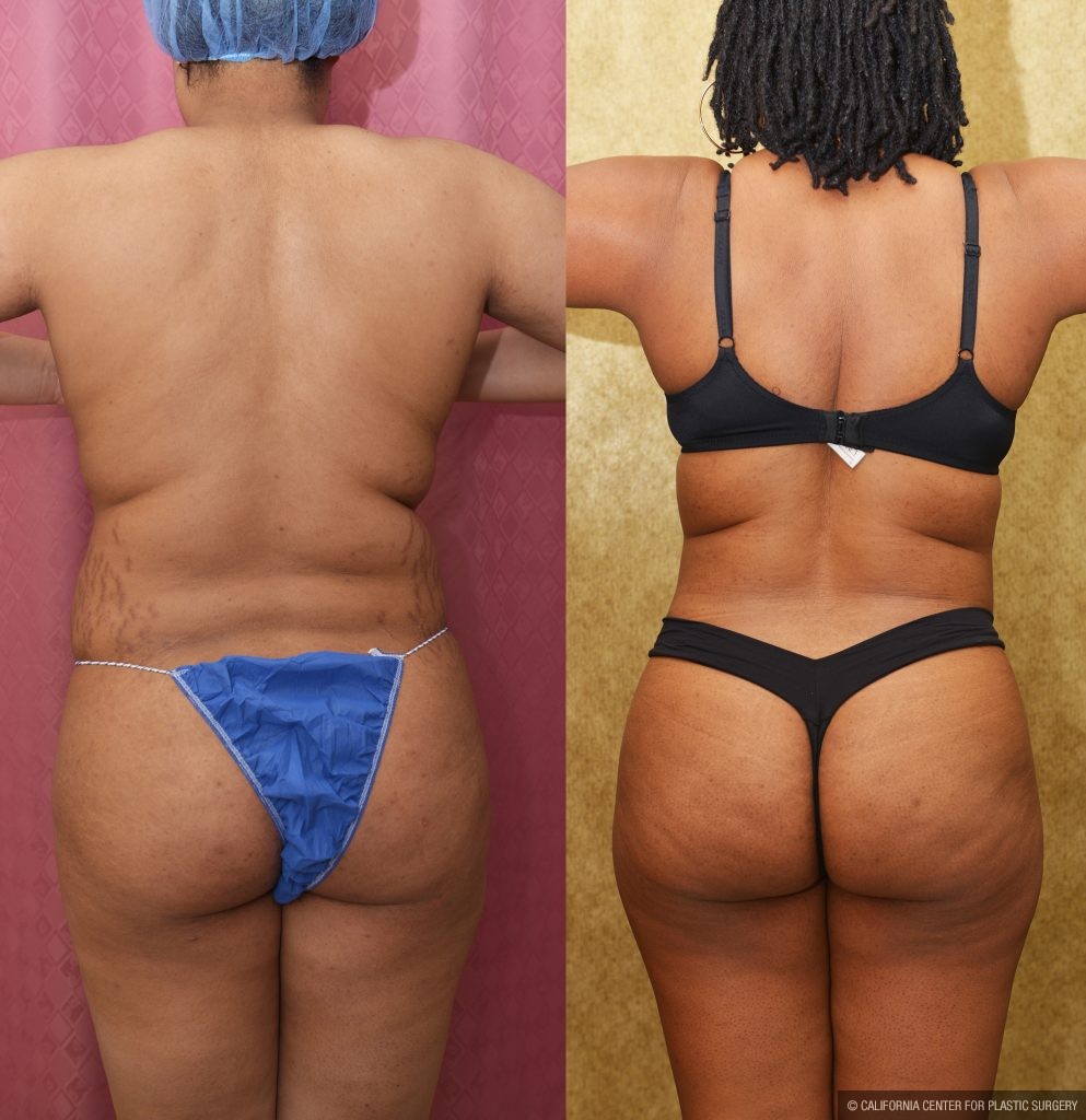 Liposuction Abdomen Medium Before & After Patient #15023
