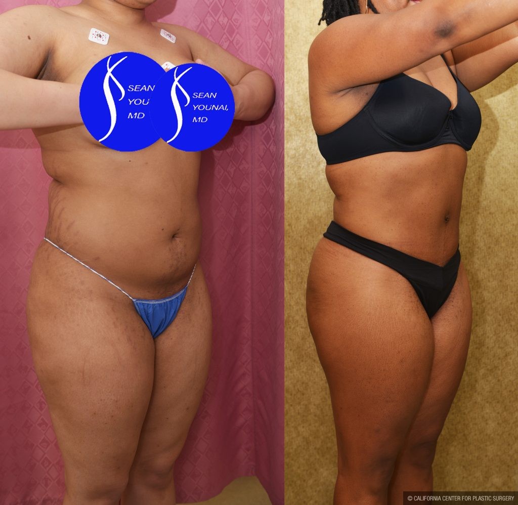 Liposuction Abdomen Medium Before & After Patient #15023