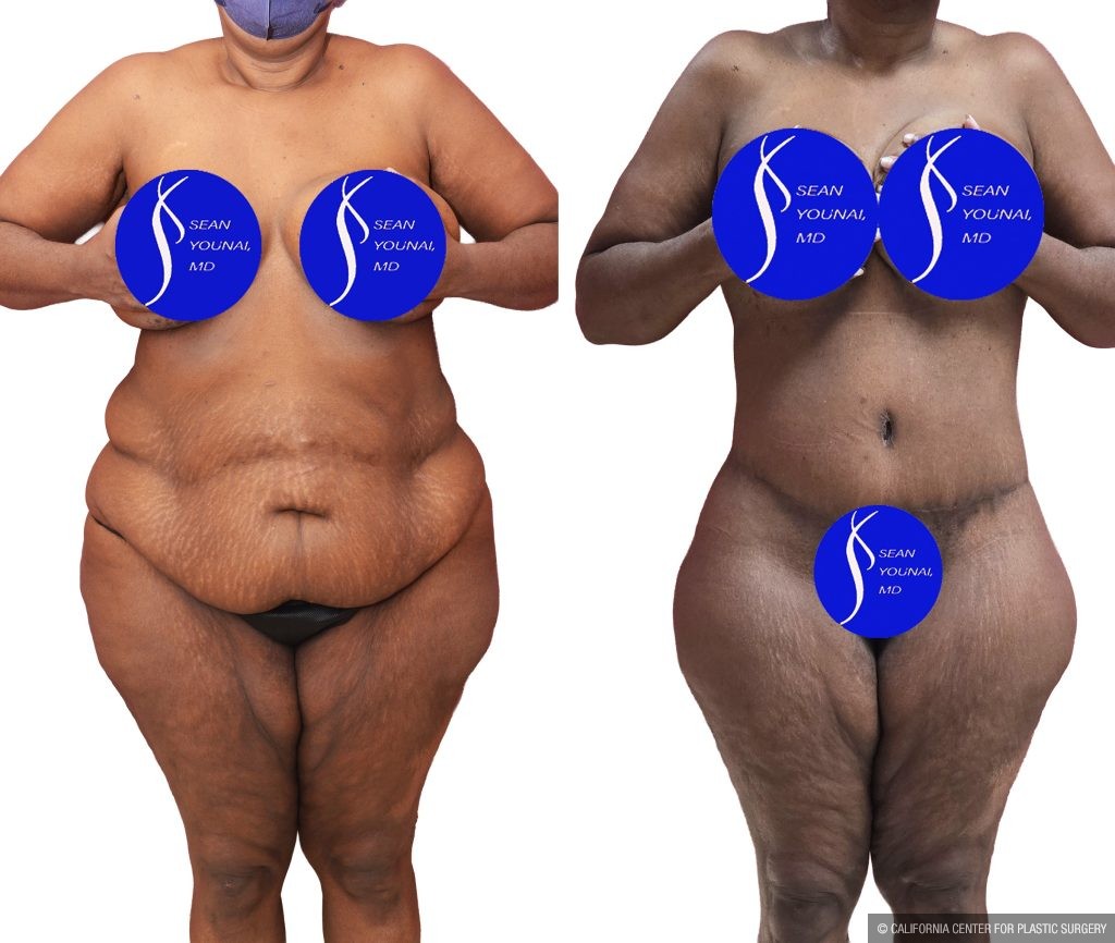 Body Lift Before & After Patient #15057