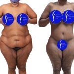 Body Lift Before & After Patient #15057