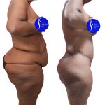 Body Lift Before & After Patient #15057