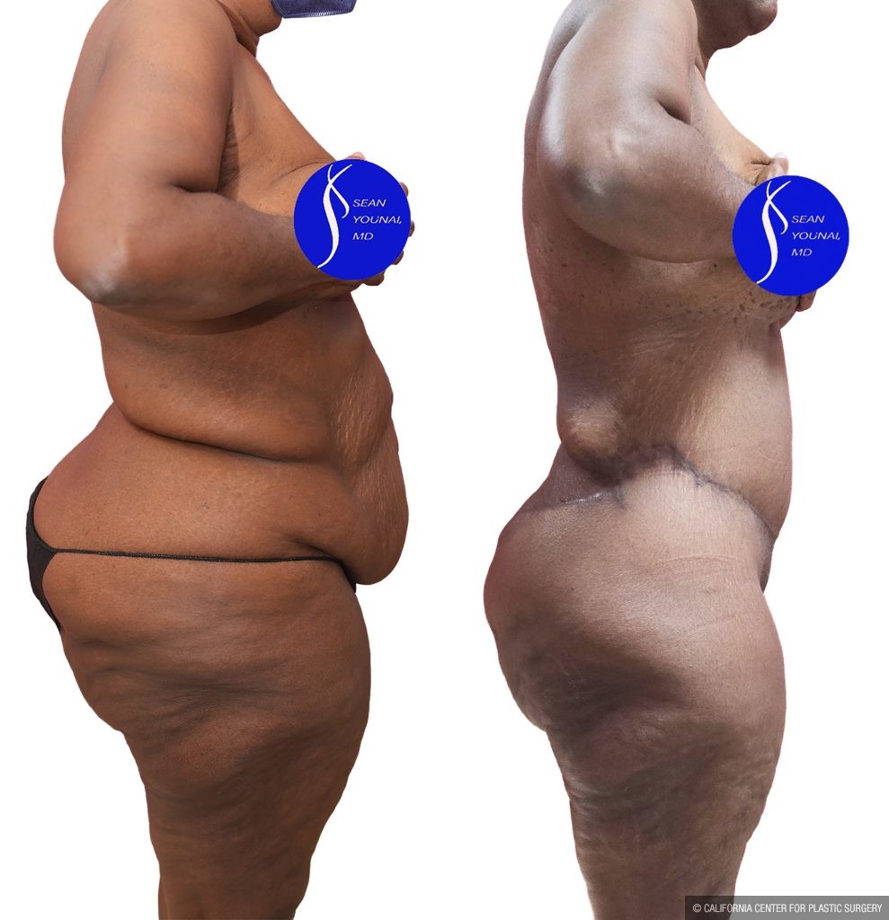 Body Lift Before & After Patient #15057