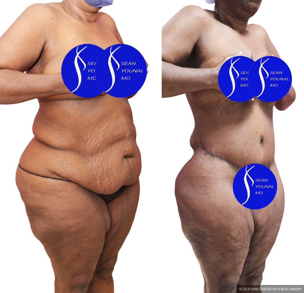 Body Lift Before & After Patient #15057