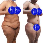 Body Lift Before & After Patient #15057