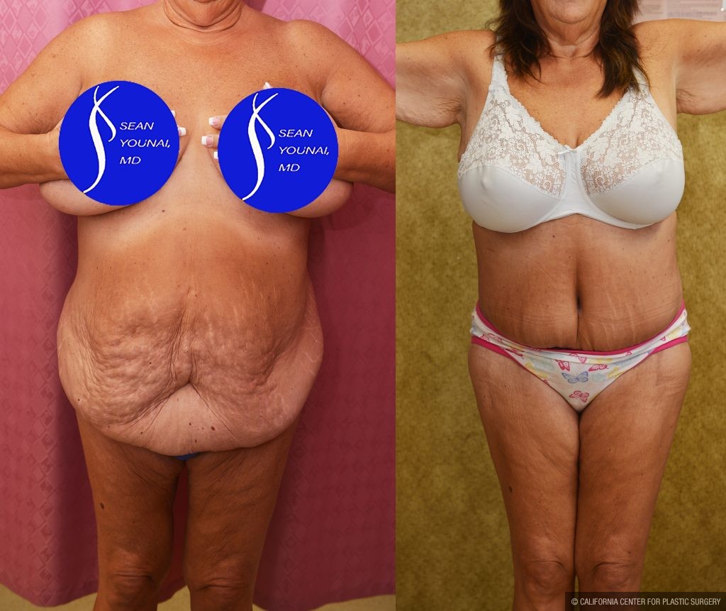 Body Lift Before & After Patient #15058