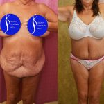 Body Lift Before & After Patient #15058