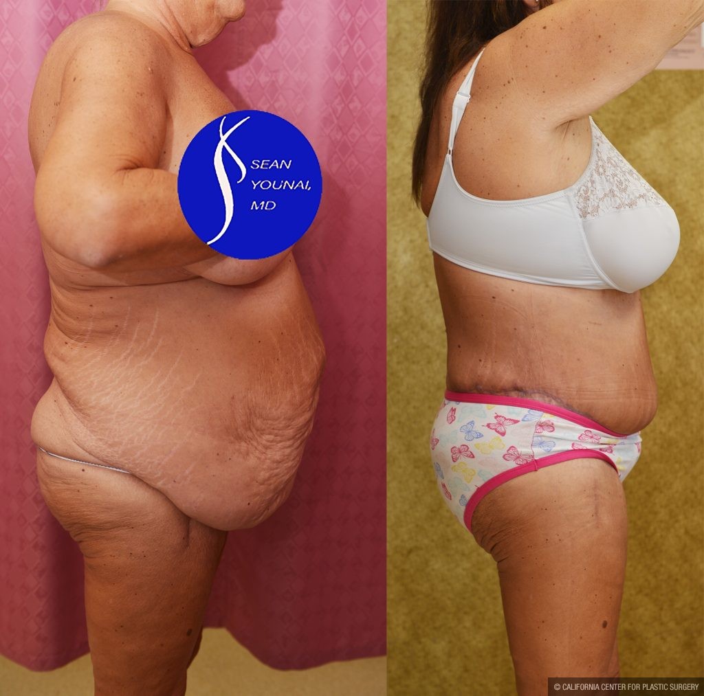 Body Lift Before & After Patient #15058