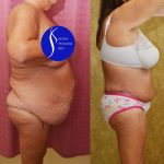 Body Lift Before & After Patient #15058