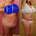 Body Lift Before & After Patient #15058