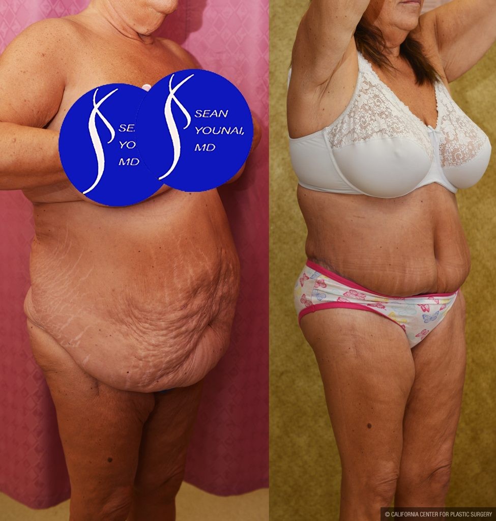 Body Lift Before & After Patient #15058