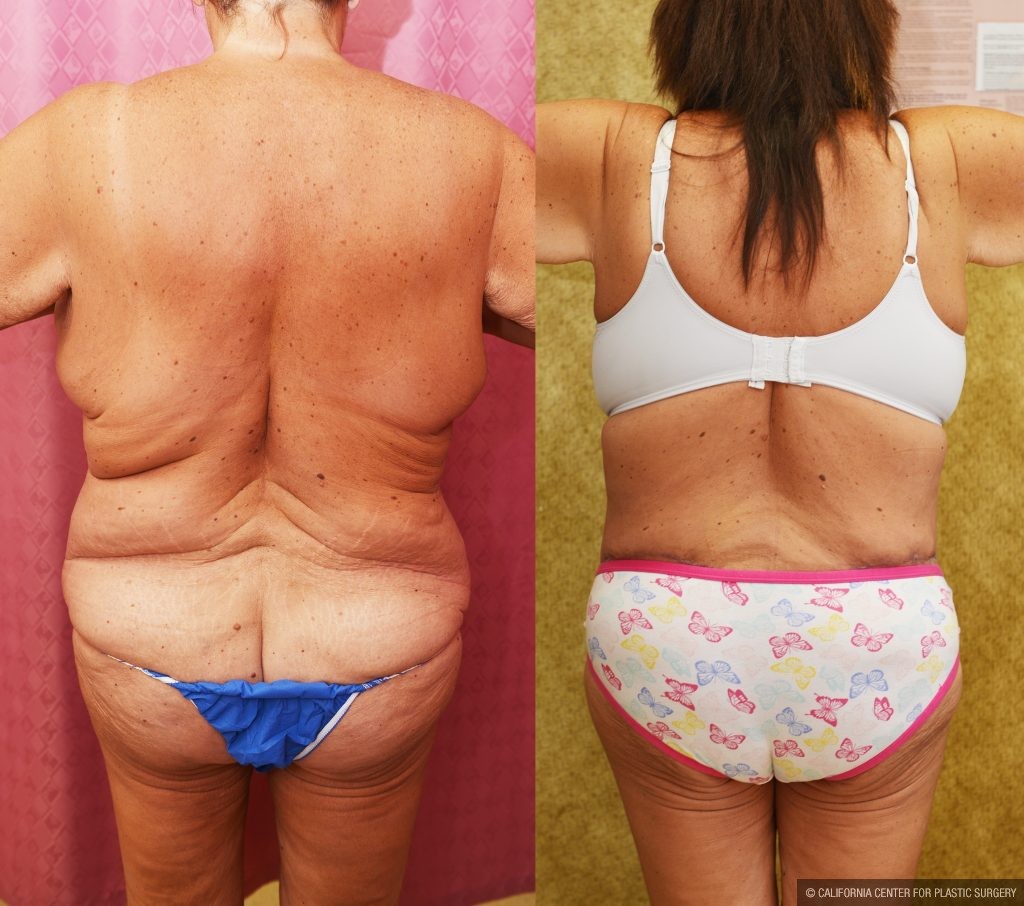 Body Lift Before & After Patient #15058