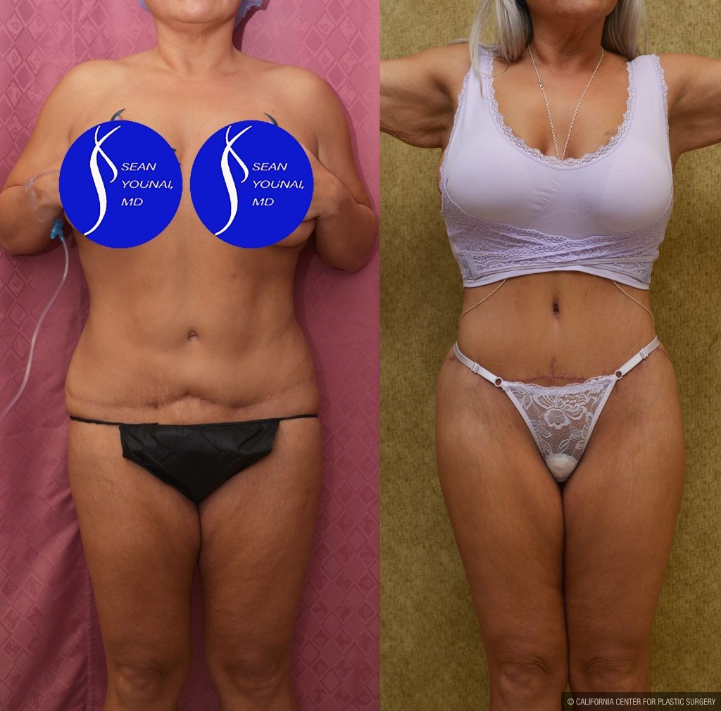 Tummy Tuck (Abdominoplasty) Revision Before & After Patient #15059