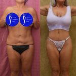 Tummy Tuck (Abdominoplasty) Revision Before & After Patient #15059
