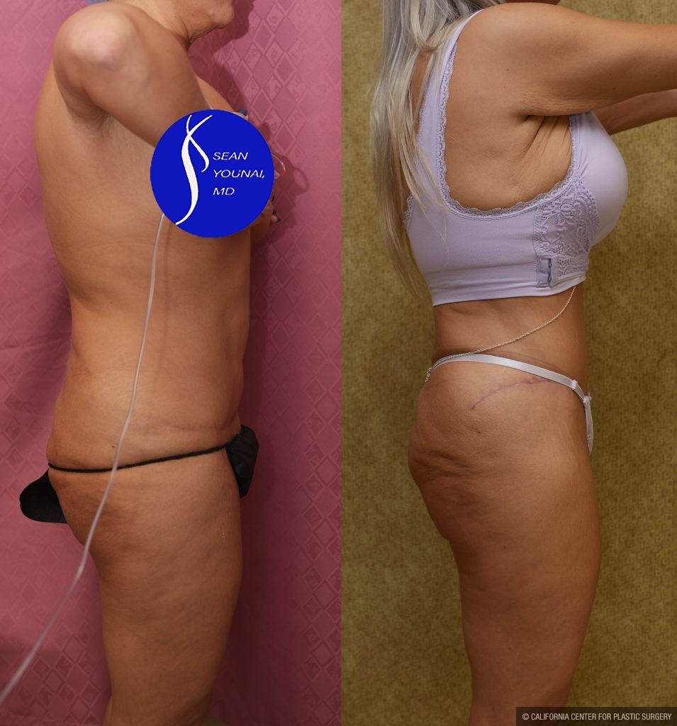 Tummy Tuck (Abdominoplasty) Revision Before & After Patient #15059