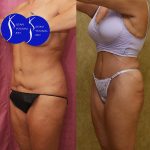 Tummy Tuck (Abdominoplasty) Revision Before & After Patient #15059