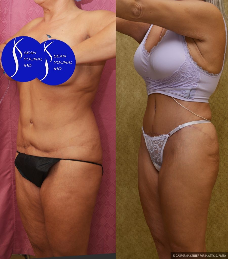 Tummy Tuck (Abdominoplasty) Revision Before & After Patient #15059
