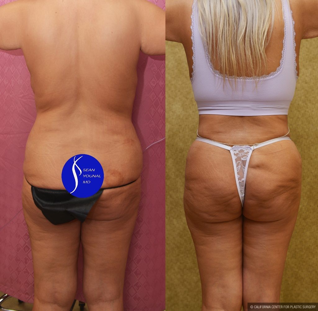 Tummy Tuck (Abdominoplasty) Revision Before & After Patient #15059