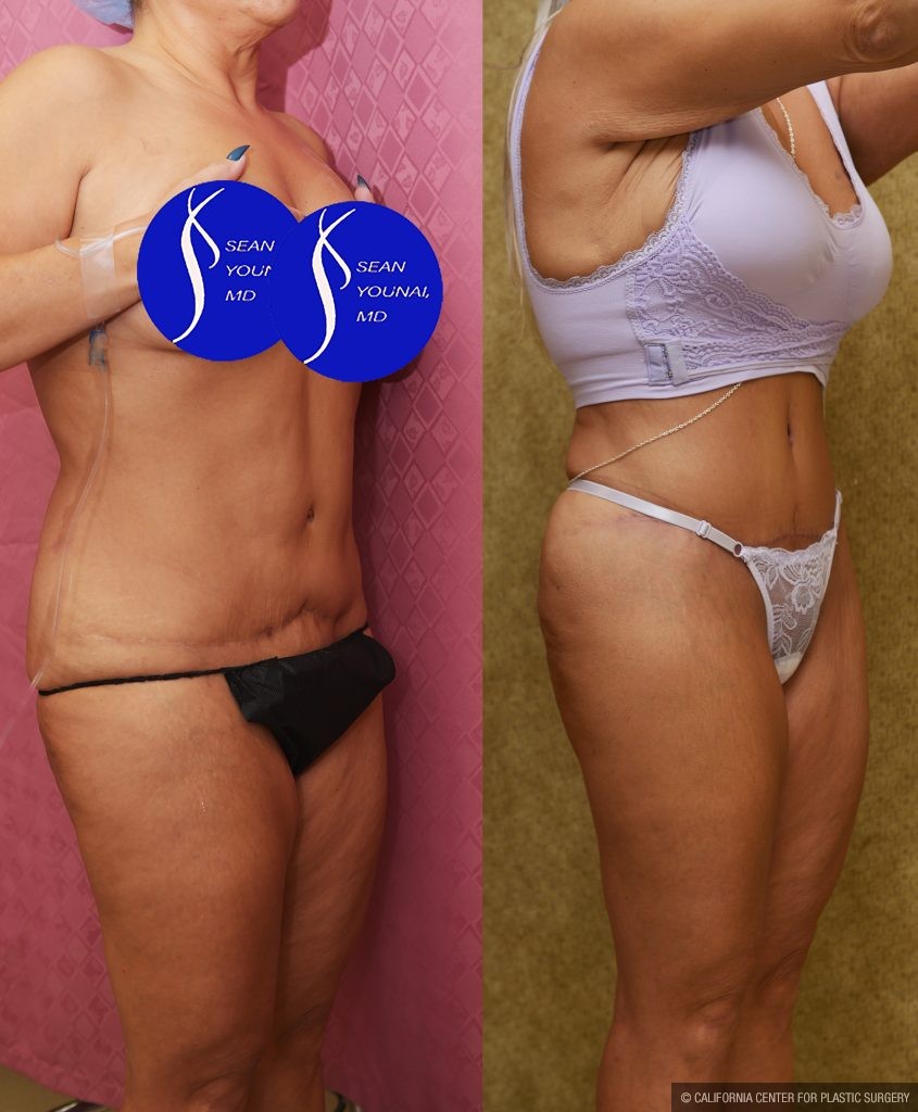 Tummy Tuck (Abdominoplasty) Revision Before & After Patient #15059