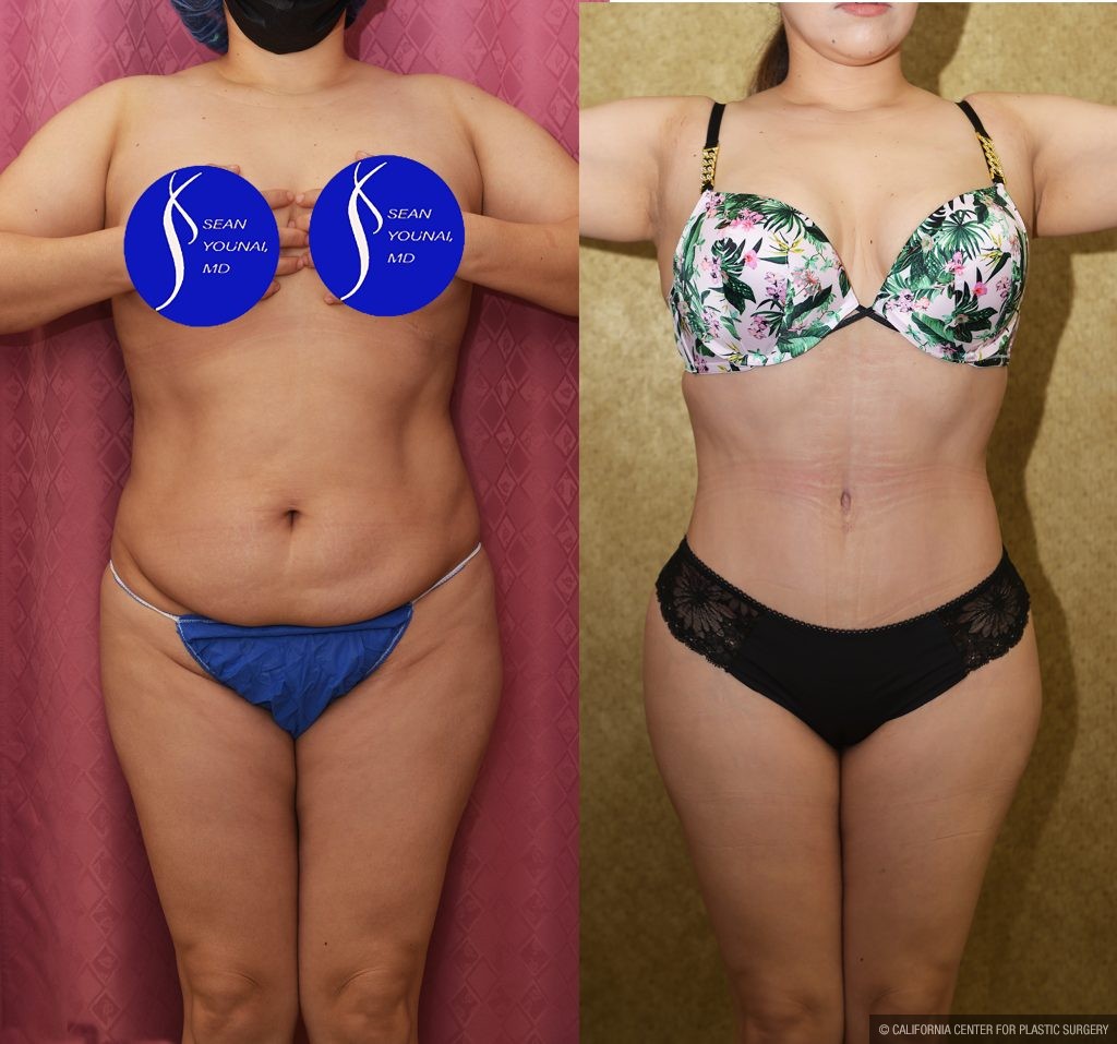 Tummy Tuck (Abdominoplasty) Small Size Before & After Patient #15060