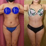 Tummy Tuck (Abdominoplasty) Small Size Before & After Patient #15060