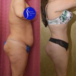 Tummy Tuck (Abdominoplasty) Small Size Before & After Patient #15060