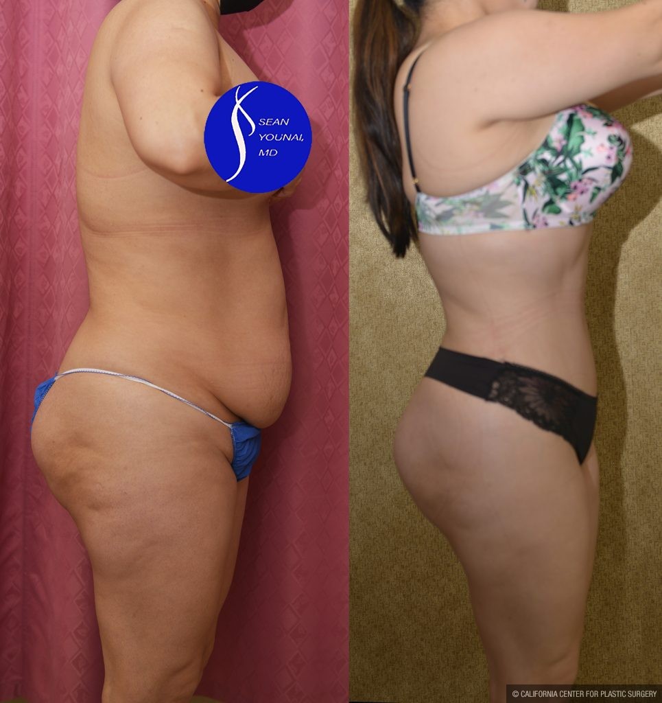 Tummy Tuck (Abdominoplasty) Small Size Before & After Patient #15060