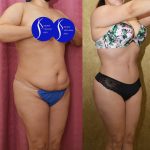 Tummy Tuck (Abdominoplasty) Small Size Before & After Patient #15060