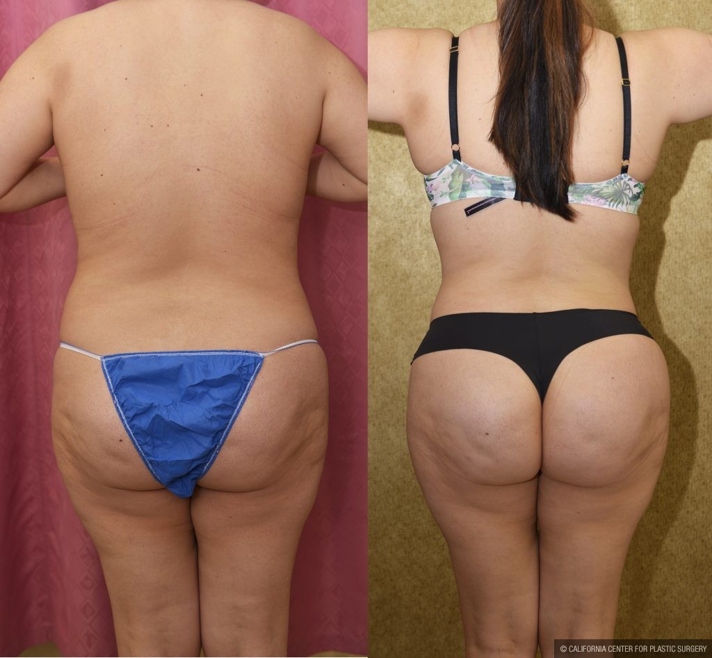 Tummy Tuck (Abdominoplasty) Small Size Before & After Patient #15060