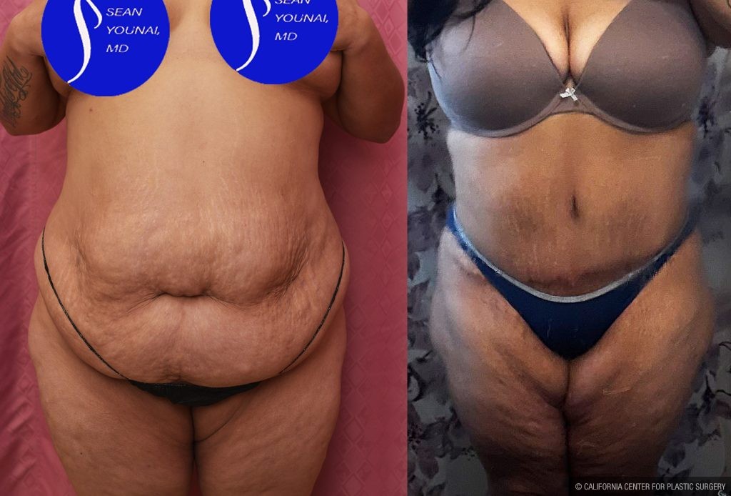 Tummy Tuck (Abdominoplasty) Super Plus Size Before & After Patient #15062
