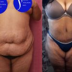 Tummy Tuck (Abdominoplasty) Super Plus Size Before & After Patient #15062