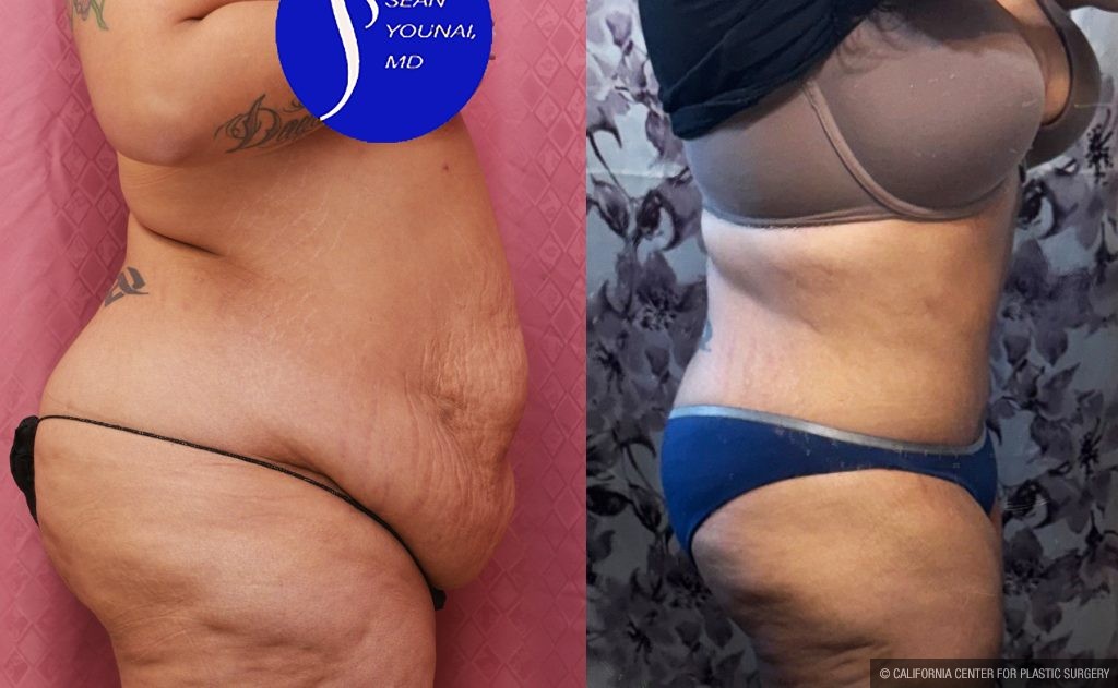 Tummy Tuck (Abdominoplasty) Super Plus Size Before & After Patient #15062