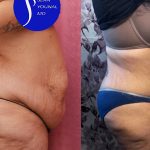 Tummy Tuck (Abdominoplasty) Super Plus Size Before & After Patient #15062